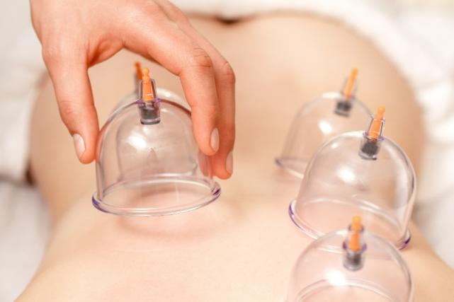 Cupping therapy Cupping therapy